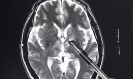 脑膜刺激征检查视频,直观解析临床诊断技巧